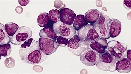 myeloid leukemia cells