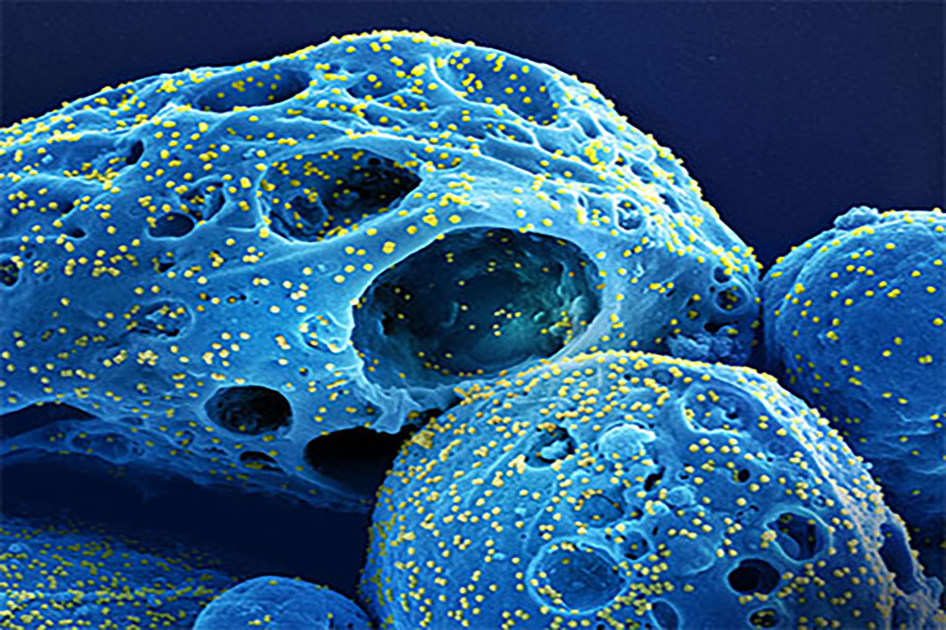 A colorized scanning electron micrograph of cells (blue) infected with the Omicron strain of SARS-CoV-2 virus (yellow), isolated from a patient sample. Variants of the original COVID-19 virus evolved to better dodge vaccine protections and immune response. 