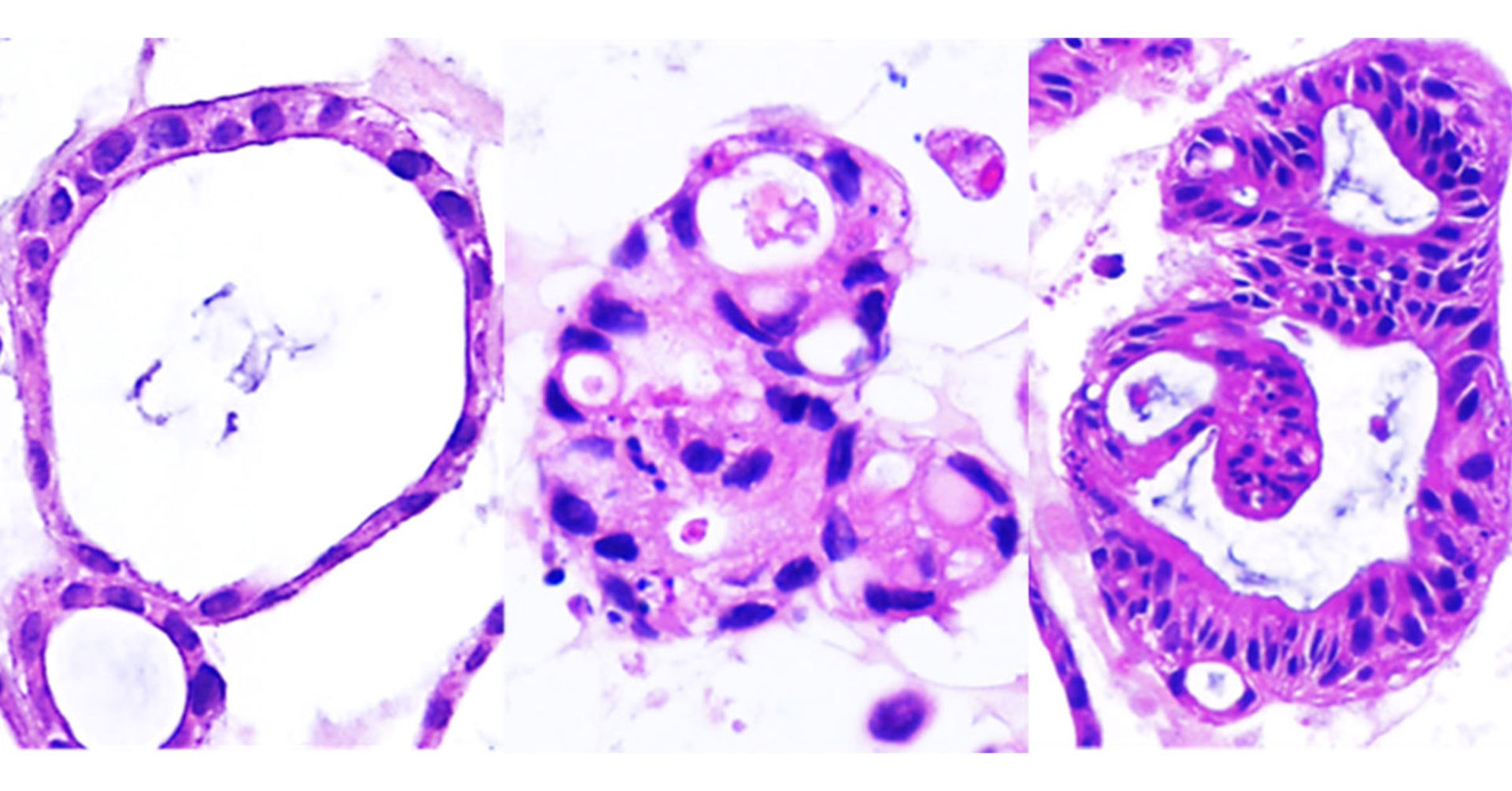Histology images of patient-derived organoids: healthy (left), Crohn’s disease SF2CD subtype (middle) and Crohn's disease IDICD (right). Photo credit: UC San Diego Health Sciences