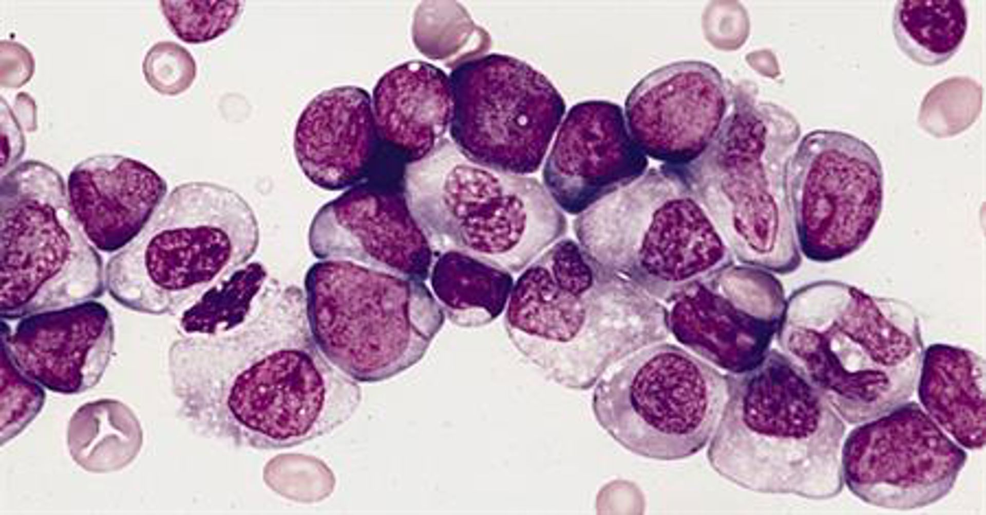 A micrograph depicts acute myeloid leukemia cells. Though treatments have dramatically advanced, AML in children can become resistant to therapy. New research suggests the reason lies not with genetic mutations, but with how genes are expressed and transcribed. Courtesy of Leukemia & Lymphoma Society